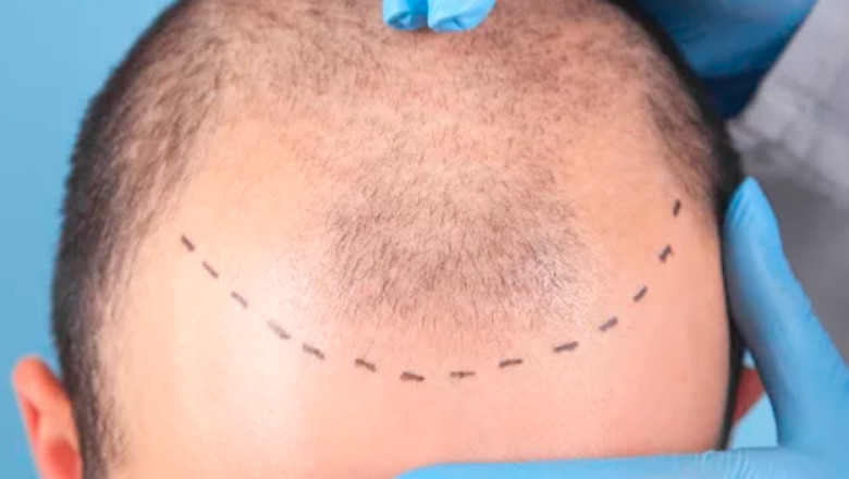 Hair Transplant in UAE: Real Patient Reviews