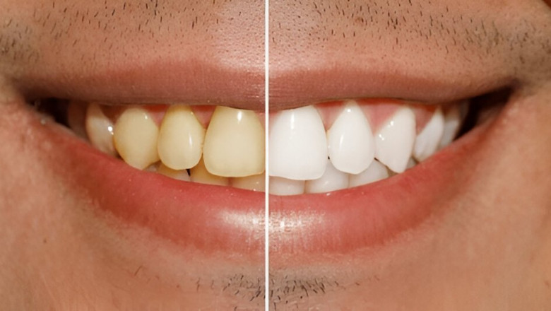 Shine Brighter: Discover the Best Teeth Whitening in Colwood