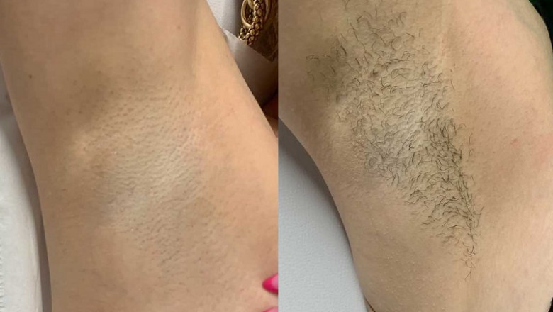 Say Hello to Smooth Skin: Why Everyone Is Choosing Laser Hair Removal