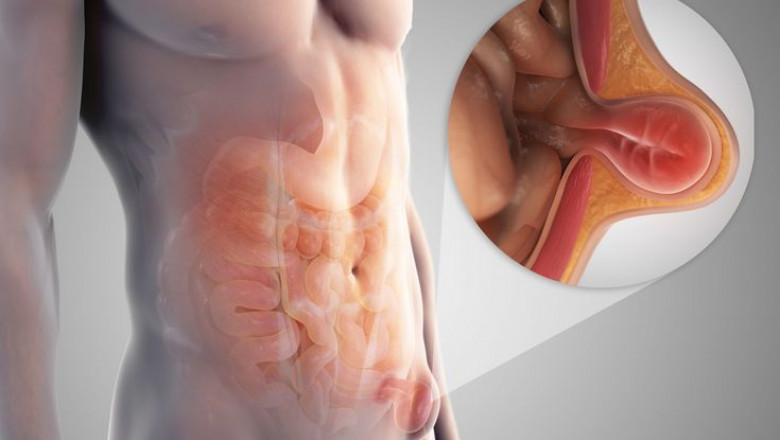 Best Hernia Surgeon in Chennai – Dr. S. Srivatsan Gurumurthy at GEM Hospital