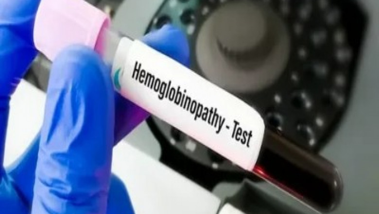 Hemoglobinopathy Treatment: Global Screening Methods and Therapeutic Innovations Driving Growth