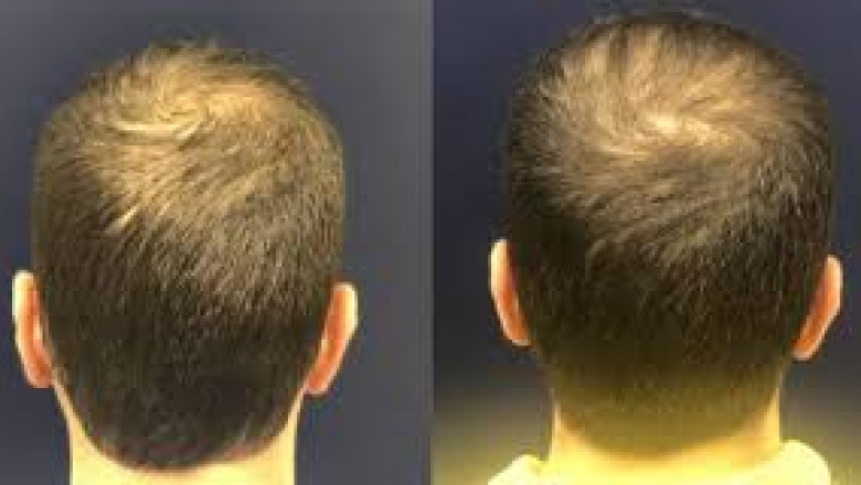 Robotic Hair Restoration: Is It the Future of Hair Transplants?