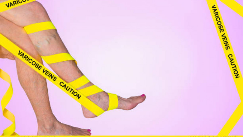 When Vein Disease Becomes a Serious Medical Emergency