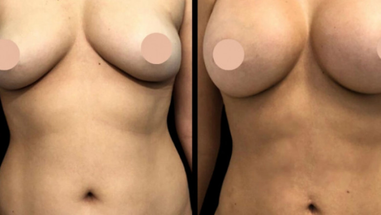 Why These Are the Best Breast Augmentation Surgeons in Dubai