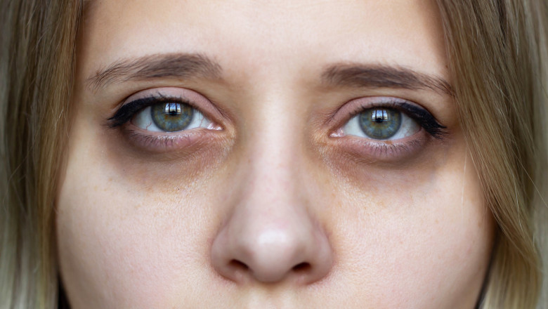 Dark Circle Treatment UAE: Clinic Package Deals