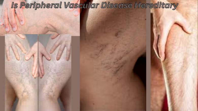 Is Peripheral Vascular Disease Hereditary?