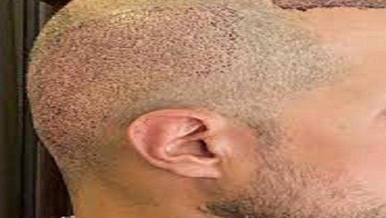 5000 Hair Grafts in Dubai: Is It Common or Excessive?