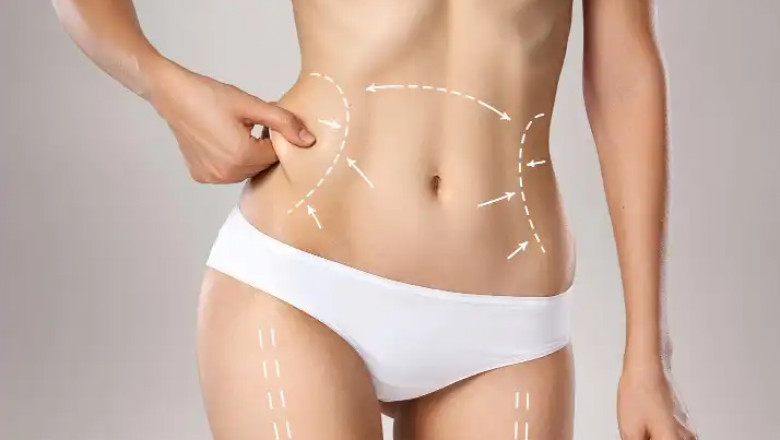 Liposuction Cost in Dubai for Tummy and Side Fat