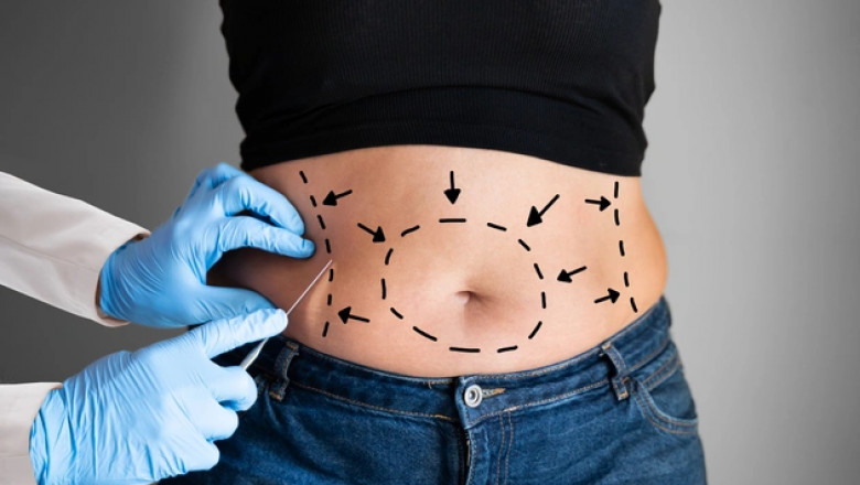 The Art and Science of Fat Reduction: Liposuction Surgery Explained at Royal Clinic Saudia