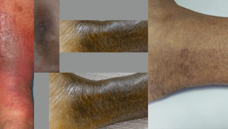 Venous Skin Ulcers: Symptoms, Stages and Treatment