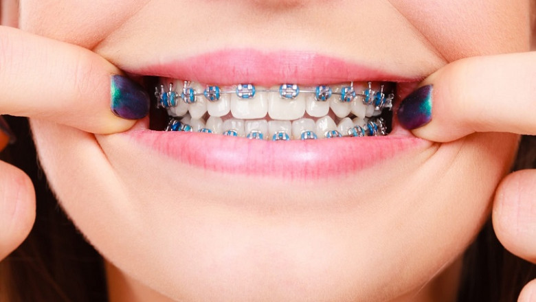Virtual Braces Consultation in Dubai: A Modern Smile Solution