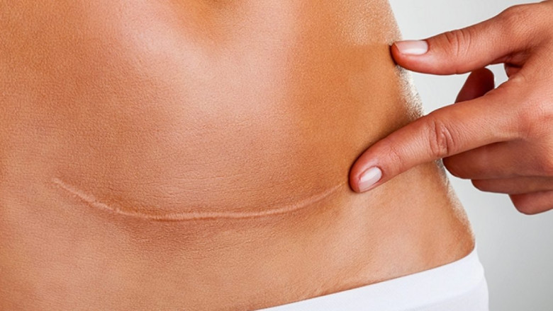Scar Removal in Dubai: Dermatologist Guide